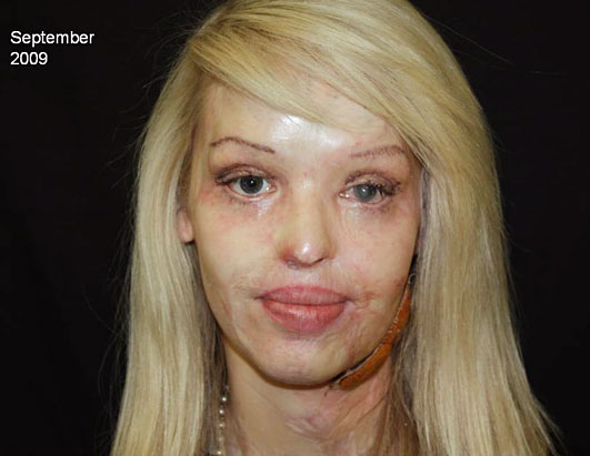Photo British model Katie Piper was brutally burned when a stranger threw
