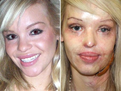 Katie Piper: British Model Burned in Sulfuric Acid Attack ...