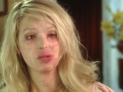 Acid+attack+model+katie+piper