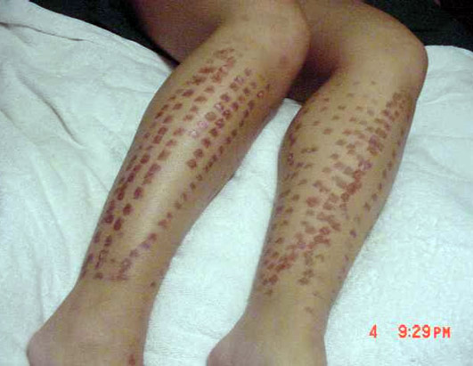Picture of extensive laser hair removal burns on legs