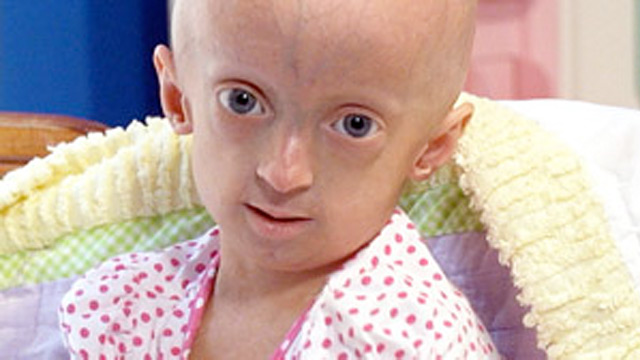 children-living-with-progeria-inside-their-world-abc-news