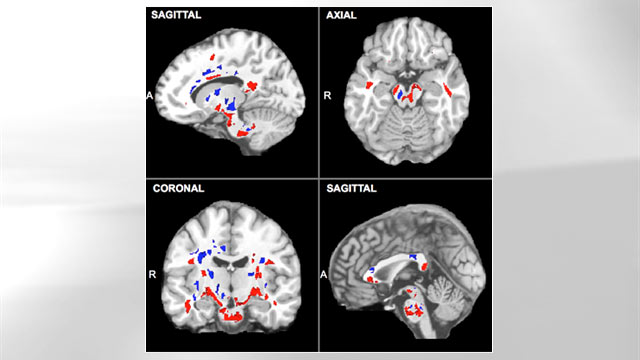 detecting-concussions-with-a-brain-scan-abc-news