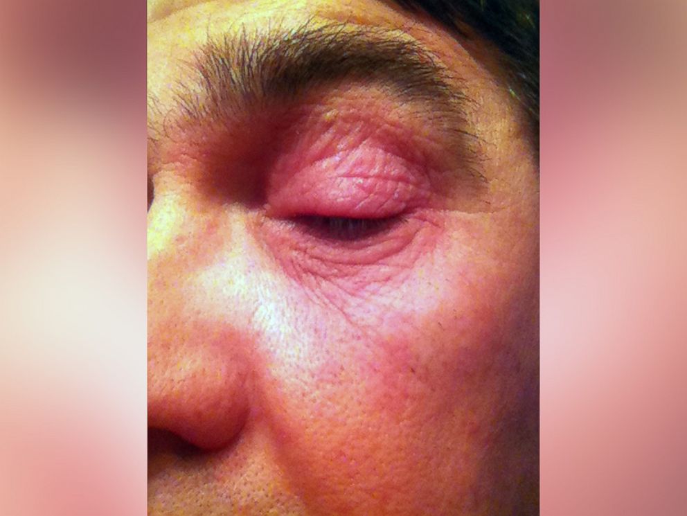 neomycin allergy - pictures, photos