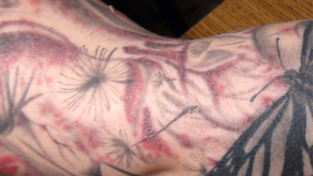 Tattoo Infection Rare | a trail of ink tracking a rare tattoo related infection Tattoo Infection Rare | a trail of ink tracking a rare tattoo related infection