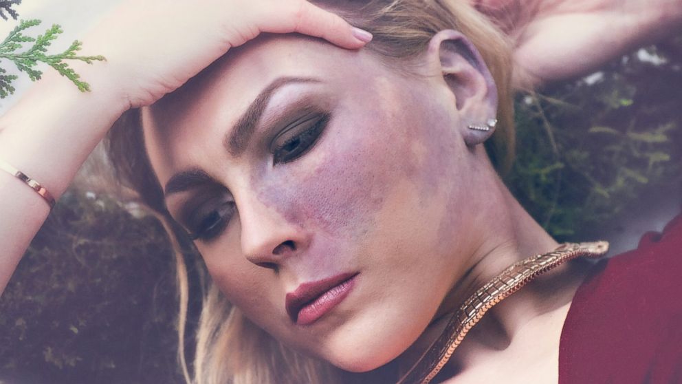 Actress Facial Birthmark Celebrated In Gorgeous Photo Series Abc News