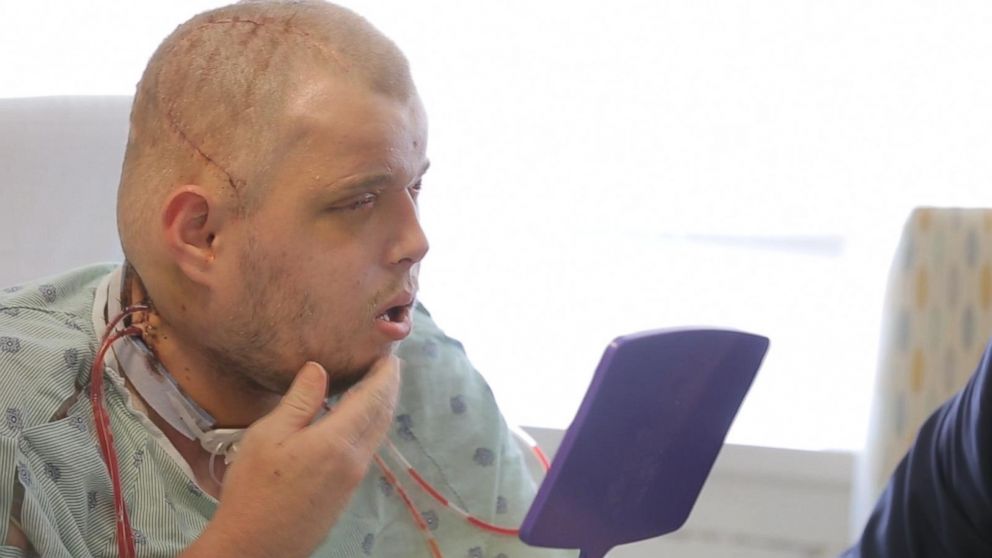 VIDEO: Face Transplant Patient Sees Himself for the First Time Post-Surgery
